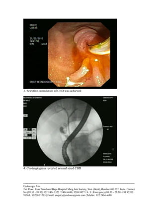 3. Selective cannulation of CBD was achieved

4. Cholangiogram revealed normal sized CBD

--------------------------------------------------------------------------------------------------------------------Endoscopy Asia
2nd Floor, Lion Tarachand Bapa Hospital Marg,Jain Society, Sion (West),Mumbai 400 022, India. Contact
No (09:30 - 20:30) 022 2404 3522 / 2404 4680, 3208 8827 / 8 / 9 | Emergency (08:30 - 23:30) +91 93200
91763 / 98200 91763 | Email: enquiry@endoscopyasia.com |Telefax: 022 2404 4680

 