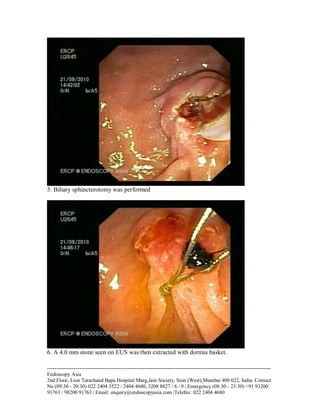 5. Biliary sphincterotomy was performed

6. A 4.0 mm stone seen on EUS was then extracted with dormia basket.
--------------------------------------------------------------------------------------------------------------------Endoscopy Asia
2nd Floor, Lion Tarachand Bapa Hospital Marg,Jain Society, Sion (West),Mumbai 400 022, India. Contact
No (09:30 - 20:30) 022 2404 3522 / 2404 4680, 3208 8827 / 8 / 9 | Emergency (08:30 - 23:30) +91 93200
91763 / 98200 91763 | Email: enquiry@endoscopyasia.com |Telefax: 022 2404 4680

 