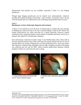 infrastructure and expertise are not available, especially if there is a non bulging
pseudocyst..
Though large bulging pseudocysts can be drained even endoscopically, whenever
possible EUS guided drainage will provide a safer window of puncture across the gut
wall and thereby prevent complications such as bleeding and perforation that can occur.
Case 3
Bleeding per rectum- Endoscopic diagnosis and treatment
A 48yrs/ F was referred to us for the favor of colonoscopy to evaluate the exact etiology
of bleeding per rectum off and on for last 6 months leading to drop in Hb. Patient was
treated conservatively for colitis and piles by a family physician. However, patient
continued to have symptoms despite several months of treatment and hence went to see a
Surgeon who asked for a colonoscopic evaluation.
Ileo-colonoscopic evaluation revealed a large 4 cms bilobed polyp with a thick stalk at
the recto-sigmoid junction. Rest of the colon upto the caecum and also the last 15 cms of
terminal ileum was normal. Polypectomy was then performed with a snare and cautery
after injection of diluted saline adrenaline into the stalk. Complete resection of the polyp
was achieved and was sent for HPE, which revealed tubulovillous adenoma without
dysplasia. Patient was sent home the same evening.

1. Large bilobed polyp with thick stalk
seen in Recto-sigmoid region.

2. Diluted saline adrenaline injected in the
stalk

--------------------------------------------------------------------------------------------------------------------Endoscopy Asia
2nd Floor, Lion Tarachand Bapa Hospital Marg,Jain Society, Sion (West),Mumbai 400 022, India. Contact
No (09:30 - 20:30) 022 2404 3522 / 2404 4680, 3208 8827 / 8 / 9 | Emergency (08:30 - 23:30) +91 93200
91763 / 98200 91763 | Email: enquiry@endoscopyasia.com |Telefax: 022 2404 4680

 