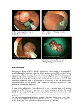 3. The stalk strangulated with a
polypectomy Snare

4. No evidence of bleeding from the
resected site

5. Polyp retrieved with a Roth net.

6. Bilobed resected polyp was sent for
histopathological examination

Expert comments
Patient above the age of 45 yrs with h/o bleeding per rectum should be investigated in
detail and empirical treatment without a definitive diagnosis should be avoided. In this
case patient suffered for almost 6 months before getting the a definitive diagnosis and
effective endoscopic treatment in the same sedation and was cured of her symptoms.
Pedunculated or even flat sessile colonic lesions can be successfully resected with
endoscopic techniques such as polypectomy as in this case or we can employ more
sophisticated tools that can perform EMR ( Endosocpic Mucosal Resection ) or ESD (
Endoscopic Submucosal Dissection).
It is our policy at Endoscopy Asia to inspect 10-15 cms of terminal ileum in all patients
referred to us for Colonoscopy and more so if we are looking for a lesion that could
bleed. It is also important to perform these procedures under one sedation at the pilot
--------------------------------------------------------------------------------------------------------------------Endoscopy Asia
2nd Floor, Lion Tarachand Bapa Hospital Marg,Jain Society, Sion (West),Mumbai 400 022, India. Contact
No (09:30 - 20:30) 022 2404 3522 / 2404 4680, 3208 8827 / 8 / 9 | Emergency (08:30 - 23:30) +91 93200
91763 / 98200 91763 | Email: enquiry@endoscopyasia.com |Telefax: 022 2404 4680

 