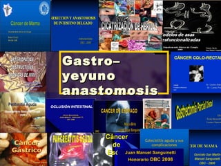 Gastro–
yeyuno
anastomosis



       Juan Manuel Sanguinetti
        Honorario DBC 2008
 
