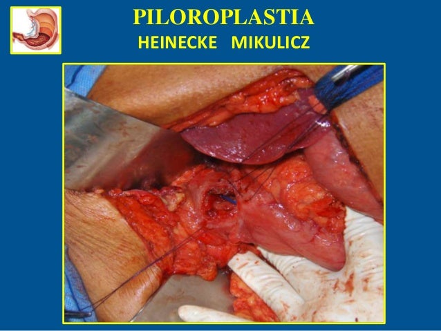 PILOROPLASTIA HEINEKE MIKULICZ EBOOK PILOROPLASTIA HEINEKE MIKULICZ EBOOK
