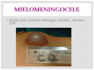 • Quiste que contiene meninges, médula , nervios y
LCR.
 
