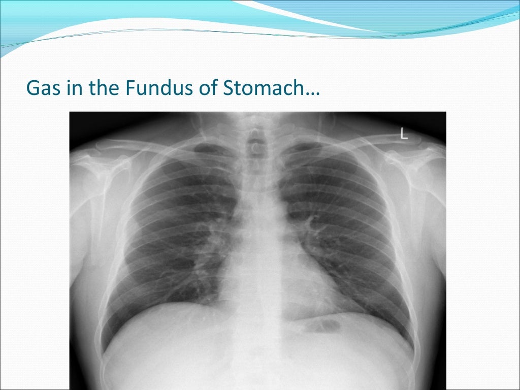 Gas Under Diaphragm Final Year MB BS Lecture
