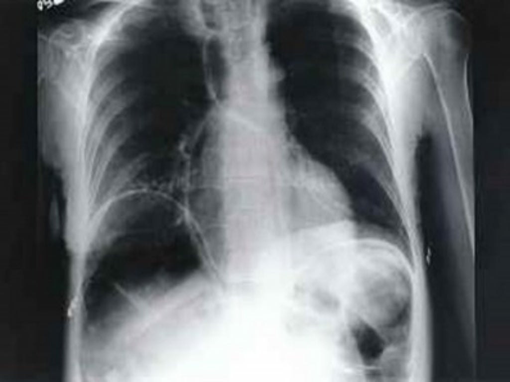 Gas Under Diaphragm Final Year MB BS Lecture