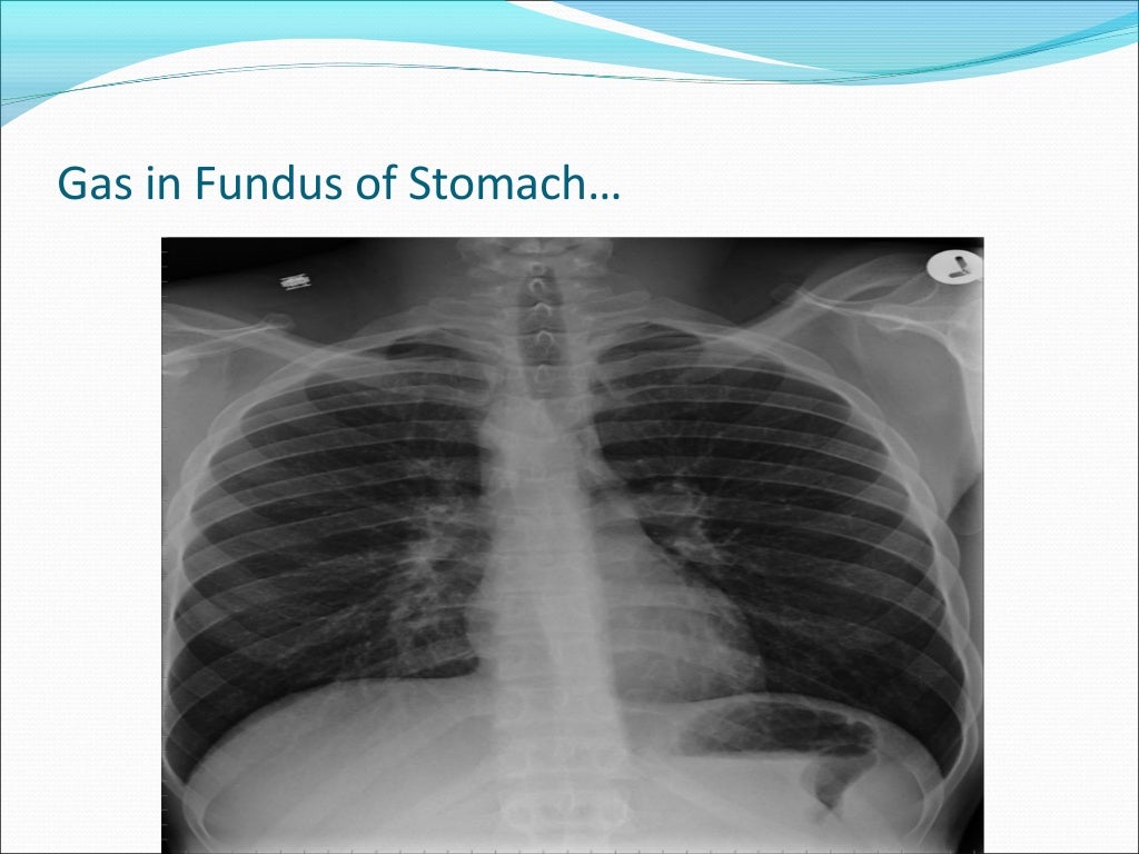 Gas Under Diaphragm Final Year MB BS Lecture