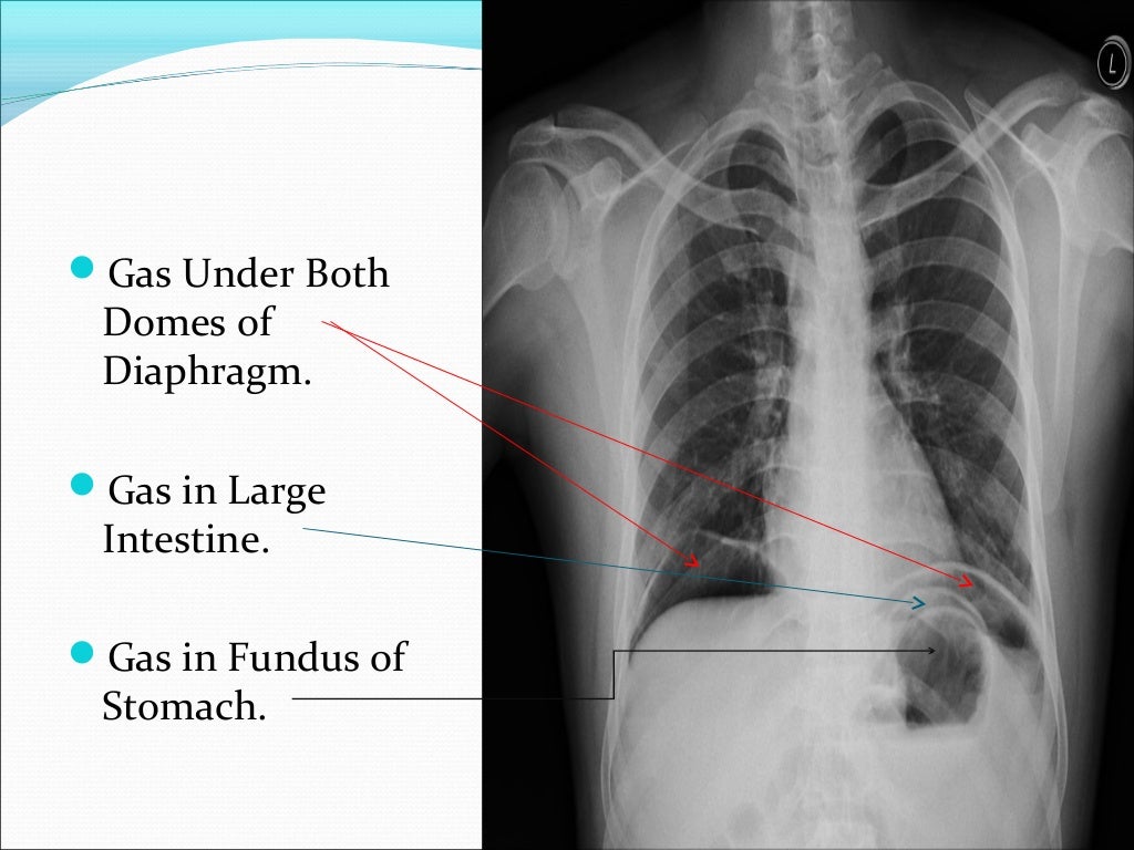 Gas Under Diaphragm Final Year MB BS Lecture