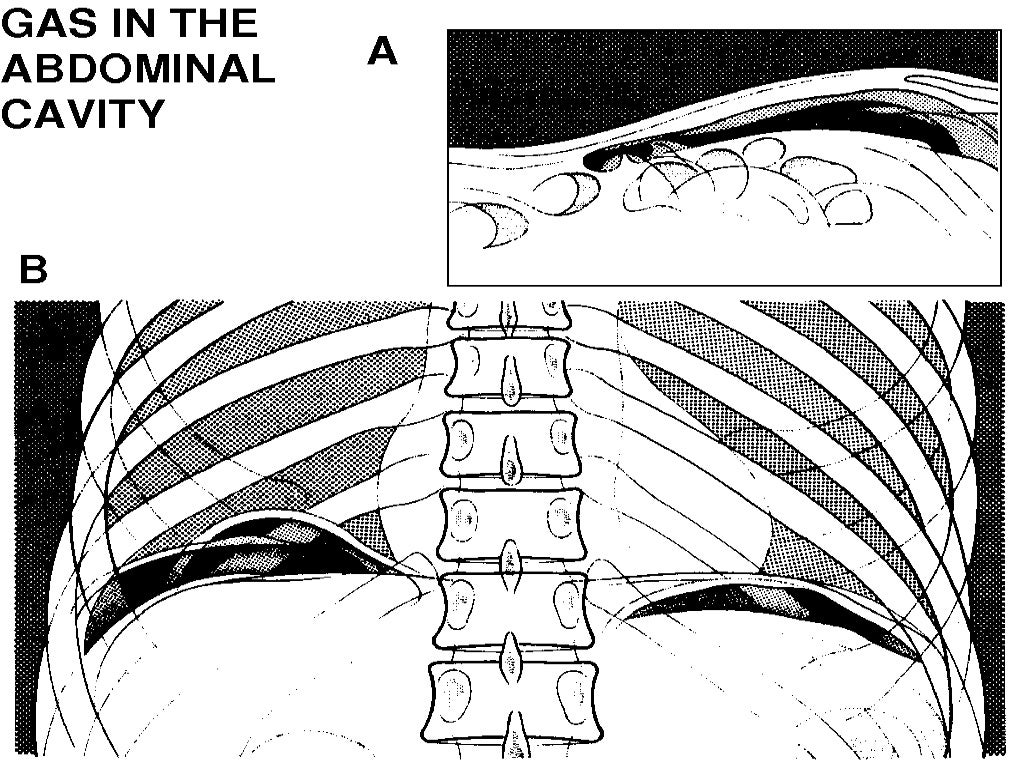 Gas Under Diaphragm Final Year MB BS Lecture