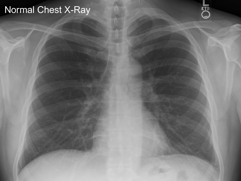 Gas Under Diaphragm Final Year MB BS Lecture