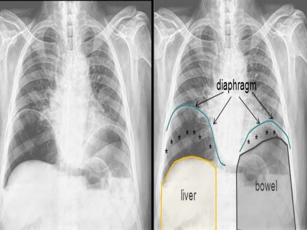 Gas Under Diaphragm Final Year MB BS Lecture Gas Under Diaphragm Final Year MB BS Lecture