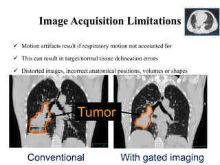 Image Acquisition Limitations
 Motion artifacts result if respiratory motion not accounted for
 This can result in target/normal tissue delineation errors
 Distorted images, incorrect anatomical positions, volumes or shapes
Conventional With gated imaging
Tumor
 