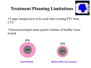Treatment Planning Limitations
Larger margins have to be used when creating PTV from
CTV
Increased margins mean greater volumes of healthy tissue
treated
CTV
CTV
PTV
PTV
Motion taken into accountConventional
 