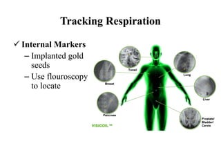 Tracking Respiration
 Internal Markers
– Implanted gold
seeds
– Use flouroscopy
to locate
 