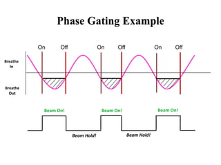 Breathe
Out
Breathe
In
Phase Gating Example
Beam On!
Beam Hold! Beam Hold!
Beam On! Beam On!
On Off On Off On Off
 