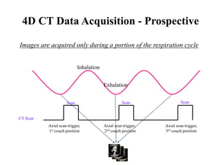 4D CT Data Acquisition - Prospective
CT Scan
Axial scan trigger,
1st couch position
Axial scan trigger,
2nd couch position
Exhalation
Inhalation
Scan Scan Scan
Axial scan trigger,
3rd couch position
Images are acquired only during a portion of the respiration cycle
 