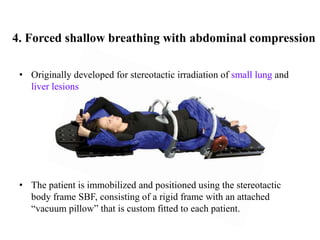 • Originally developed for stereotactic irradiation of small lung and
liver lesions
• The patient is immobilized and positioned using the stereotactic
body frame SBF, consisting of a rigid frame with an attached
“vacuum pillow” that is custom fitted to each patient.
4. Forced shallow breathing with abdominal compression
 
