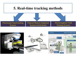 5. Real-time tracking methods
Fluoroscopy based tracking
Systems
Fiducial Markers Implanted
Systems (Gold Seeds)
Electromagnetic Field
Tracking Systems
 