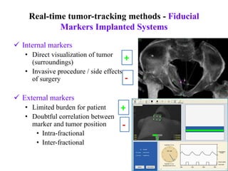 Real-time tumor-tracking methods - Fiducial
Markers Implanted Systems
 Internal markers
• Direct visualization of tumor
(surroundings)
• Invasive procedure / side effects
of surgery
 External markers
• Limited burden for patient
• Doubtful correlation between
marker and tumor position
• Intra-fractional
• Inter-fractional
+
-
-
+
 