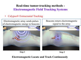 Real-time tumor-tracking methods -
Electromagnetic Field Tracking Systems
• Calypso® Extracranial Tracking
Step 1 Step 2
Electromagnetic Locate and Track Continuously
Electromagnetic array sends pulses
of electromagnetic energy to beacons
Beacons return electromagnetic
signal to the array
 