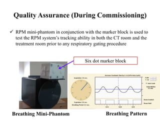 Quality Assurance (During Commissioning)
 RPM mini-phantom in conjunction with the marker block is used to
test the RPM system’s tracking ability in both the CT room and the
treatment room prior to any respiratory gating procedure
Breathing Mini-Phantom
Six dot marker block
Breathing Pattern
 