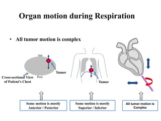 • All tumor motion is complex
Tumor
Cross-sectional View
of Patient’s Chest
Tumor
Some motion is mostly
Anterior / Posterior
Some motion is mostly
Superior / Inferior
All tumor motion is
Complex
Organ motion during Respiration
Ant
Post
 