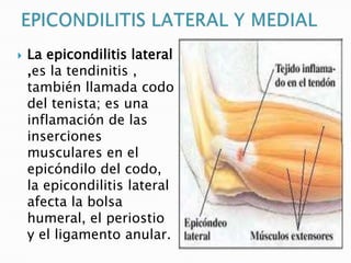    La epicondilitis lateral
    ,es la tendinitis ,
    también llamada codo
    del tenista; es una
    inflamación de las
    inserciones
    musculares en el
    epicóndilo del codo,
    la epicondilitis lateral
    afecta la bolsa
    humeral, el periostio
    y el ligamento anular.
 