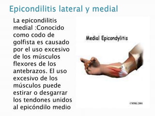 La epicondilitis
medial :Conocido
como codo de
golfista es causado
por el uso excesivo
de los músculos
flexores de los
ant...