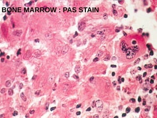 BONE MARROW : PAS STAIN
 