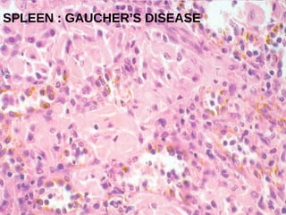 SPLEEN : GAUCHER’S DISEASE
 