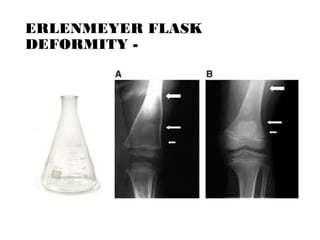 ERLENMEYER FLASK
DEFORMITY -
 