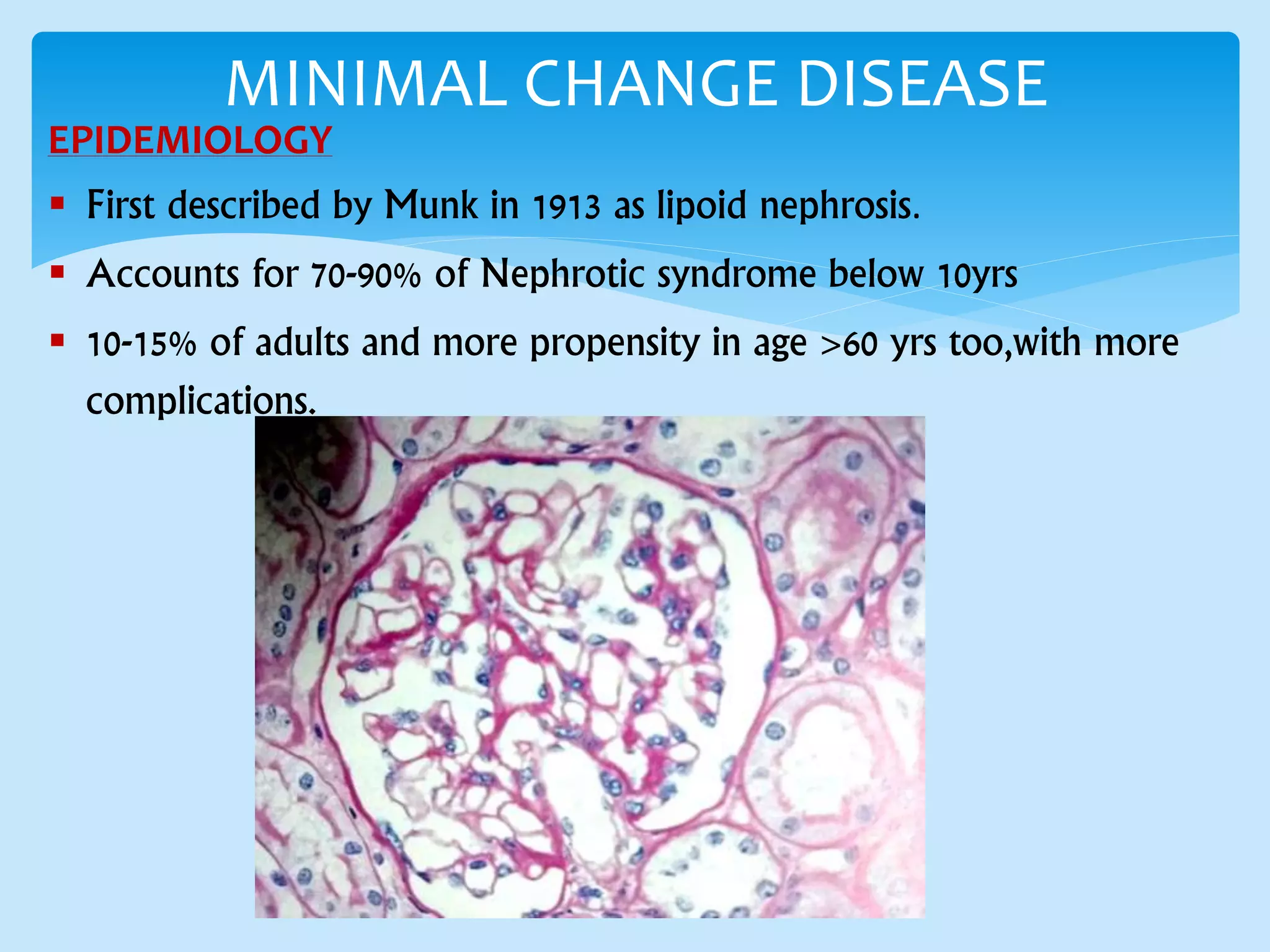 EPIDEMIOLOGY
 First described by Munk in 1913 as lipoid nephrosis.
 Accounts for 70-90% of Nephrotic syndrome below 10yrs
 10-15% of adults and more propensity in age >60 yrs too,with more
complications.
MINIMAL CHANGE DISEASE
 