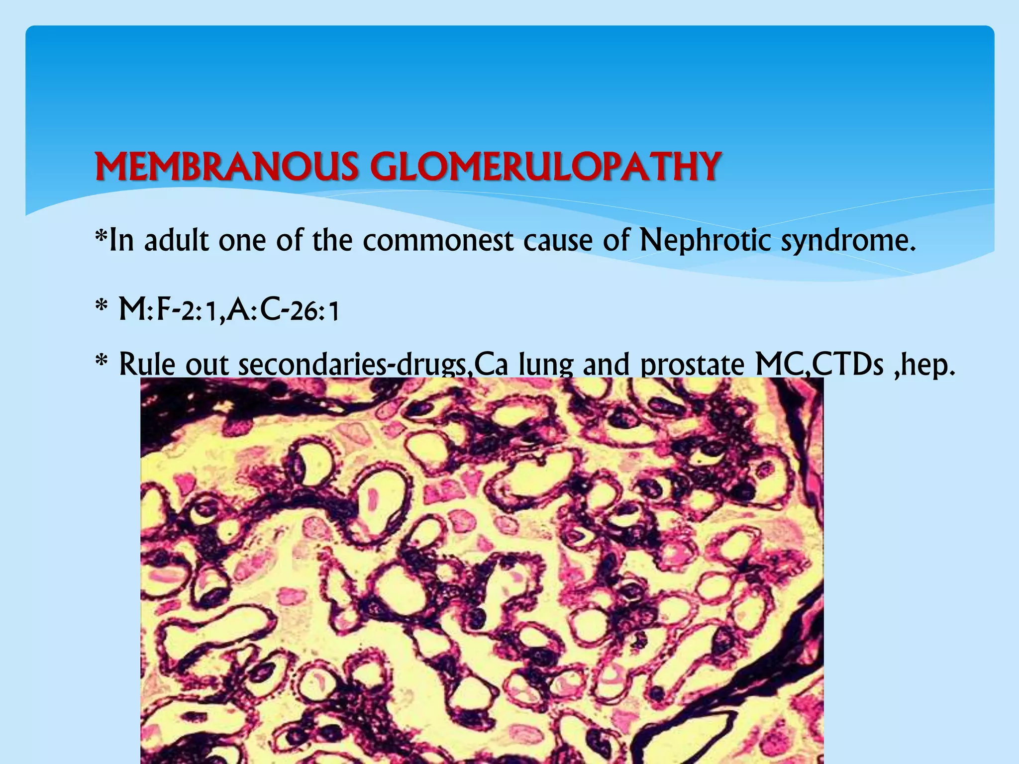 MEMBRANOUS GLOMERULOPATHY
*In adult one of the commonest cause of Nephrotic syndrome.
* M:F-2:1,A:C-26:1
* Rule out secondaries-drugs,Ca lung and prostate MC,CTDs ,hep.
 