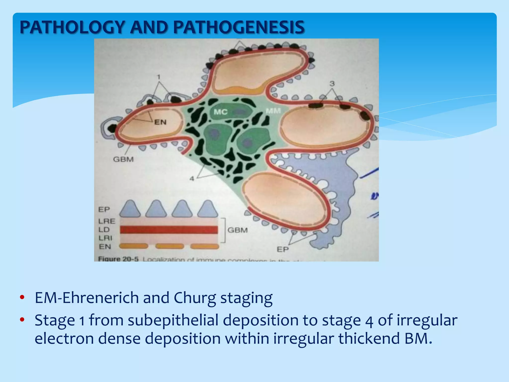 PATHOLOGY AND PATHOGENESIS
• EM-Ehrenerich and Churg staging
• Stage 1 from subepithelial deposition to stage 4 of irregular
electron dense deposition within irregular thickend BM.
 