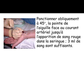 Ponctionner obliquement
à 45°, la pointe de
l’aiguille face au courant
artériel jusqu’à
l’apparition de sang rouge
dans la seringue ; 3 ml de
sang sont suffisants.

 