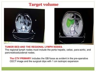 Target volume
TUMOR BED AND THE REGIONAL LYMPH NODES.
The regional lymph nodes must include the porta hepatis, celiac, para-aortic, and
pancreaticoduodenal nodes.
The CTV PRIMARY includes the GB fossa as evident in the pre-operative
CECT image and the surgical clips with 1 cm isotropic expansion
 