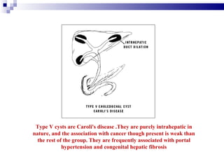 Caroli Types Gb And Pancreas (1) | PPT