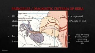 Large AN arising
from I/L 8th nerve
compressing
brainstem on C/L
side.
DR.GIRISH.S
 