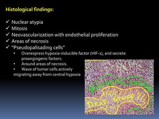 Histological findings:
 Nuclear atypia
 Mitosis
 Neovascularization with endothelial proliferation
 Areas of necrosis
 “Pseudopalisading cells”
• Overexpress hypoxia-inducible factor (HIF-1), and secrete
proangiogenic factors.
• Around areas of necrosis.
• Wave of tumor cells actively
migrating away from central hypoxia
 