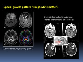 Special growth pattern (trough white matter):
Uncinate fasciculus (simultaneous
frontal and temporal lobe tumors)
Corpus callosum (butterfly glioma)
 