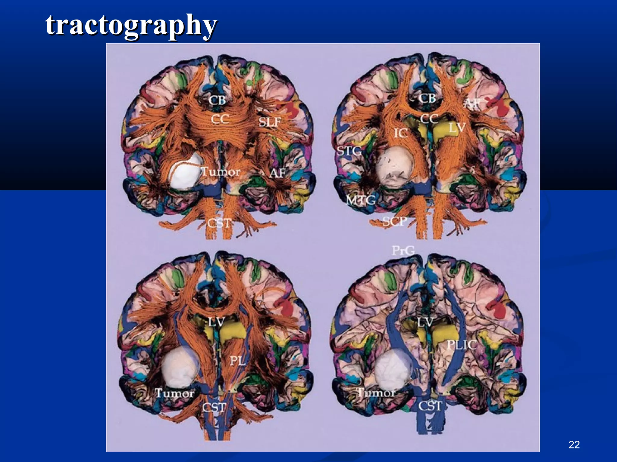 tractography




               22
 