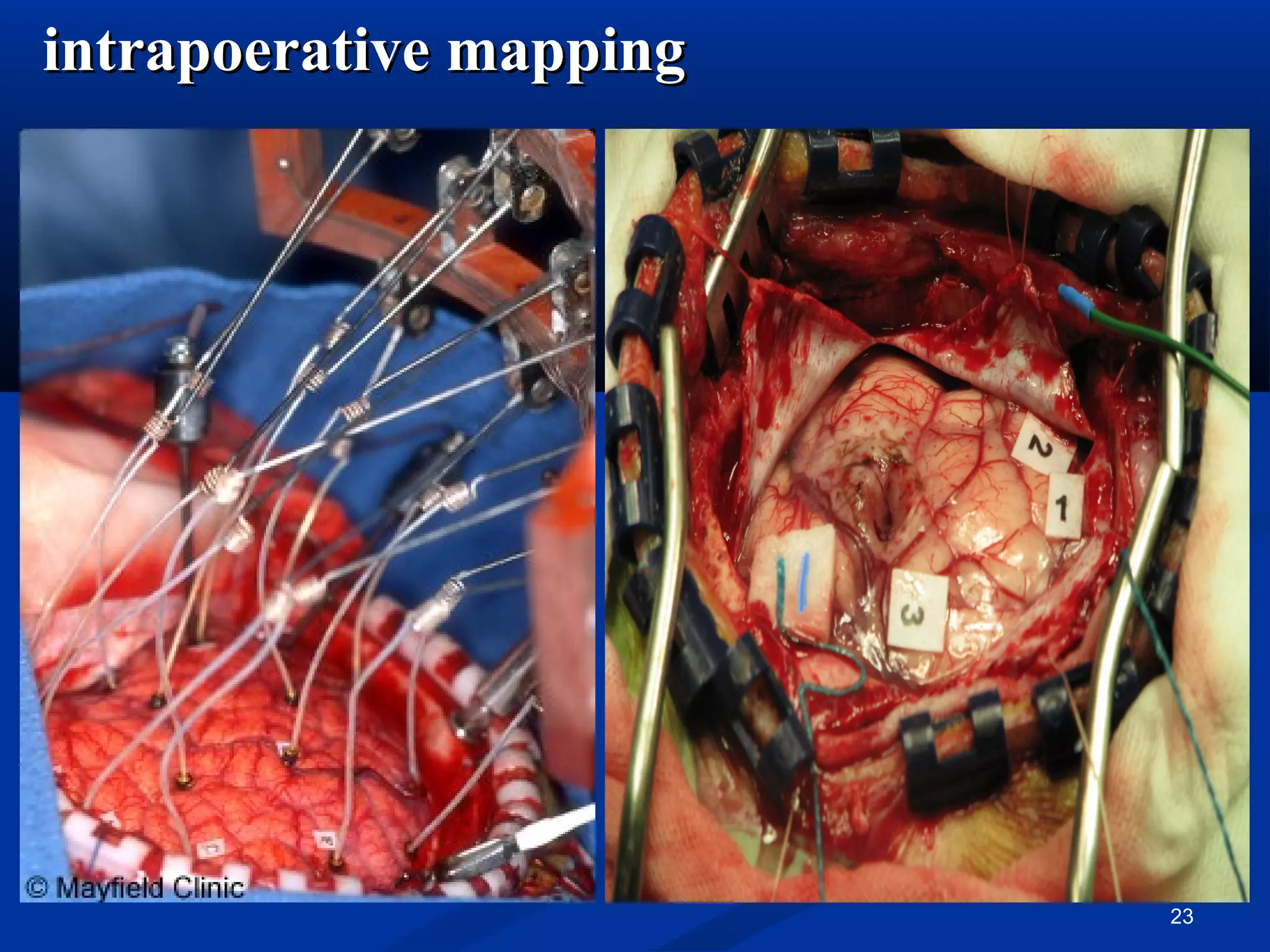 intrapoerative mapping




                         23
 