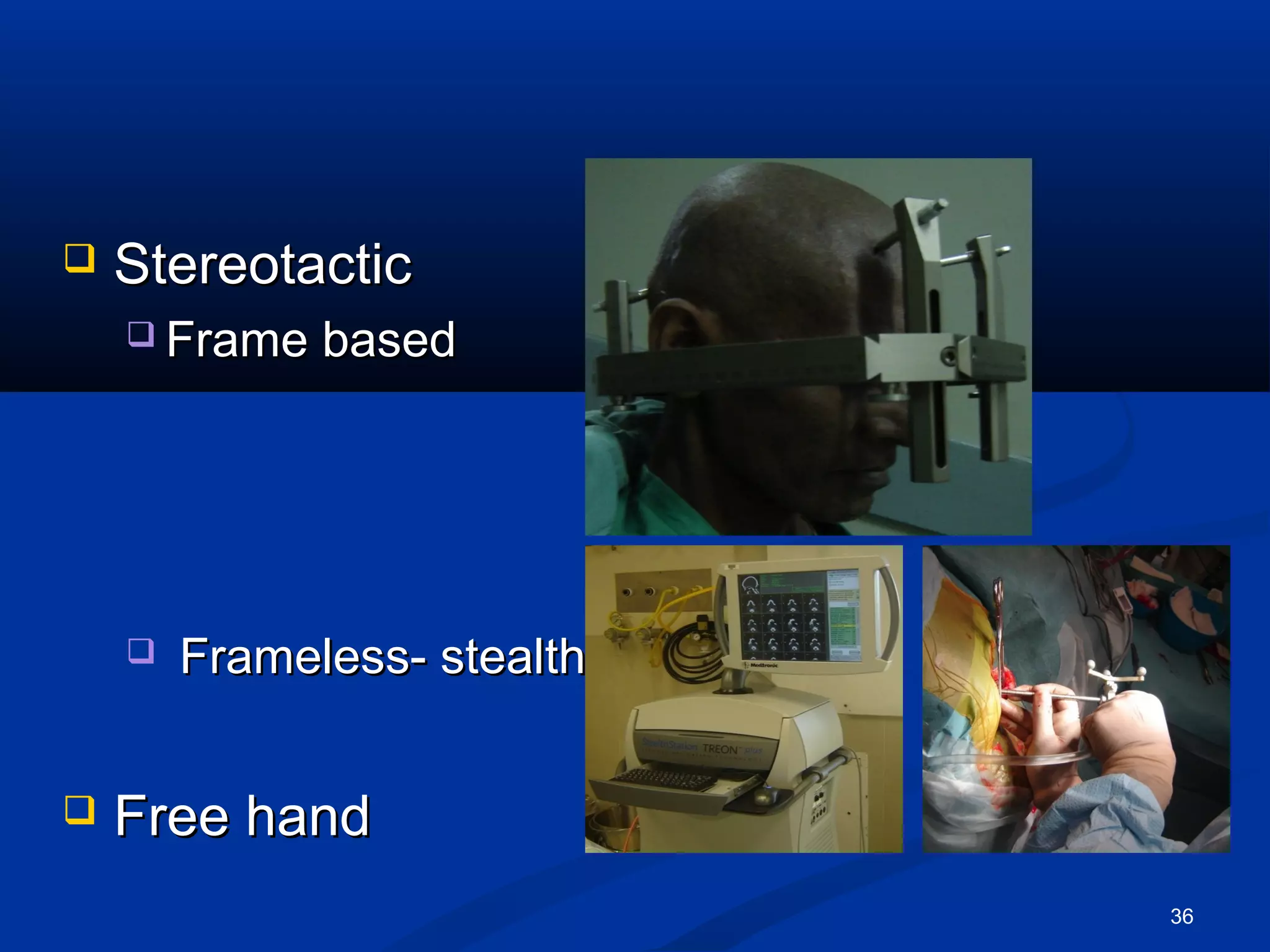    Stereotactic
     Frame   based




       Frameless- stealth


   Free hand
                             36
 