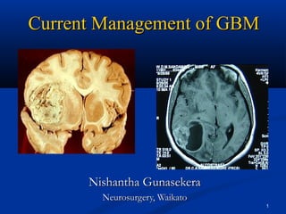 Current Management of GBM




      Nishantha Gunasekera
        Neurosurgery, Waikato
                                1
 