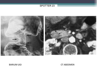 CT ABDOMENBARIUM UGI
113
SPOTTER 23
 