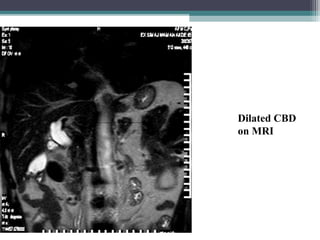 Dilated CBD
on MRI
 