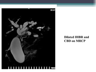 Dilated IHBR and
CBD on MRCP
 