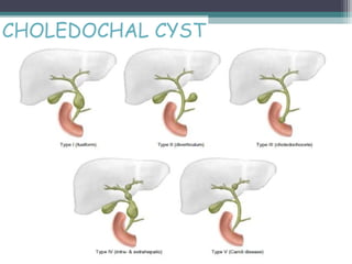 CHOLEDOCHAL CYST
 