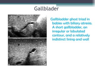 Gallblader
Gallbladder ghost triad in
babies with biliary atresia.
A short gallbladder, an
irregular or lobulated
contour, and a relatively
indistinct lining and wall
 