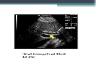 PSC with thickening of the wall of the bile
duct (arrow)
 