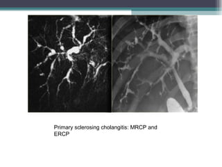 Primary sclerosing cholangitis: MRCP and
ERCP
 